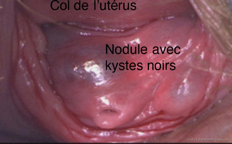 Est-ce que l'endométriose se voit dans une prise de sang ? La vérité sur le diagnostic biologique actuel
