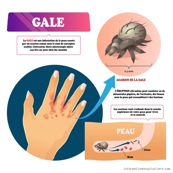 Est-ce que le citron tué la gale ? La vérité sur ce remède de grand-mère
