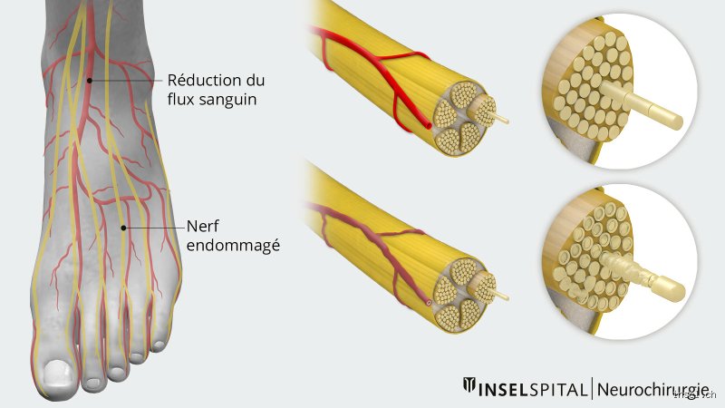 Est-ce que le diabète empêche de marcher ? Comprendre l'impact réel de la glycémie sur votre mobilité quotidienne