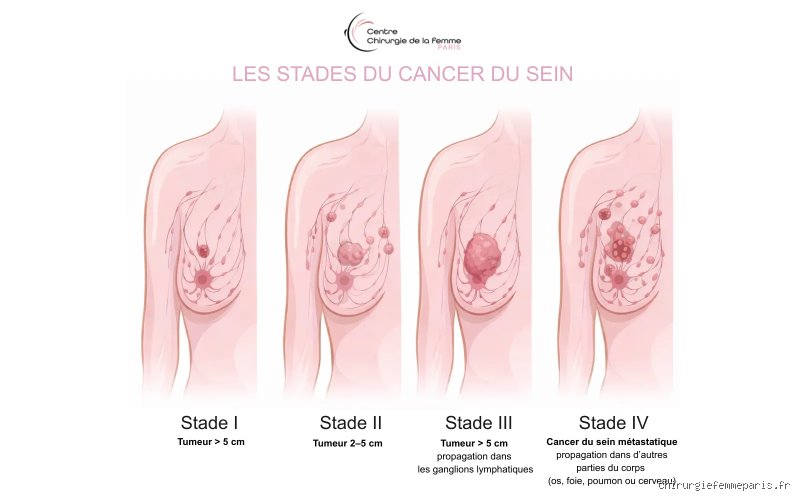 Est-il possible d’avoir un cancer de stade 4 sans aucun symptôme ? Le silence troublant des métastases