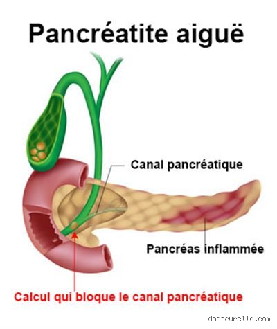 Est-il possible de traiter une pancréatite sans hospitalisation ? Ce que les nouvelles protocoles disent vraiment en 2024