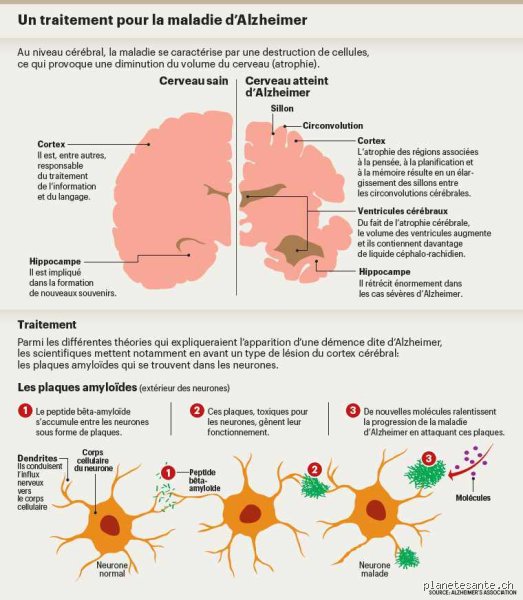 Existe-t-il un remède contre les maladies neurodégénératives ? Entre espoirs thérapeutiques et réalités cliniques en 2026