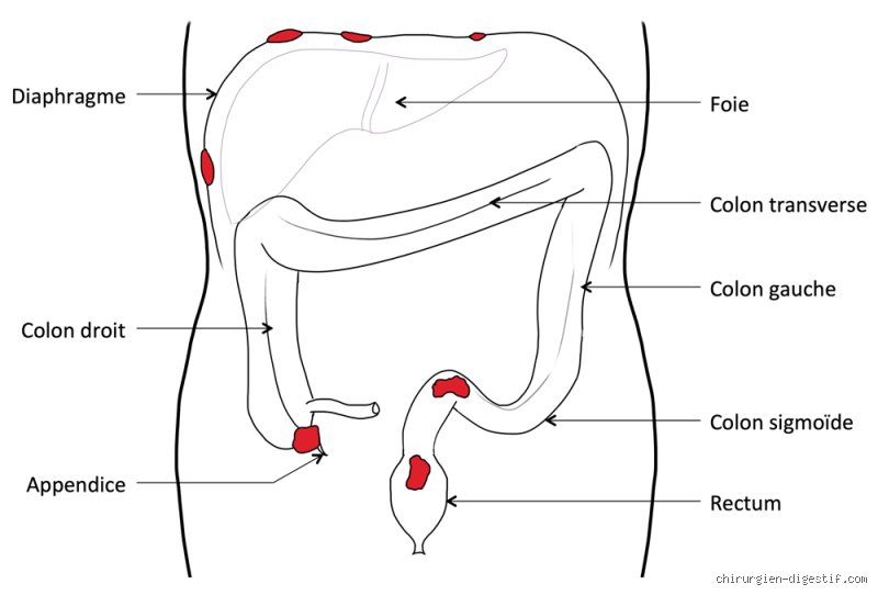 L'endométriose peut-elle être confondue avec une diverticulite ? Quand le diagnostic s'égare entre gynécologie et gastro-entérologie