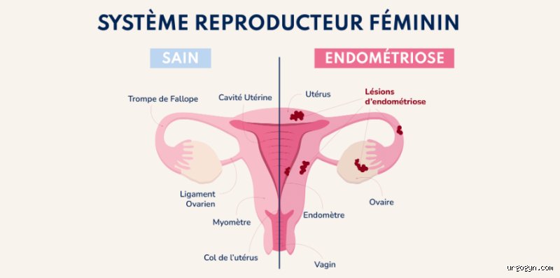 L'ibuprofène réduit-il l'inflammation liée à l'endométriose ? Analyse médicale d'un réflexe qui ne soigne pas tout