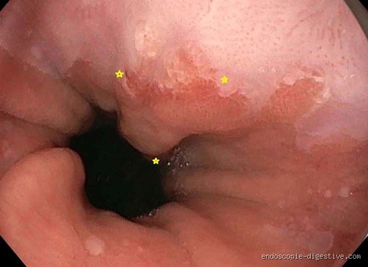 Le cancer de l'œsophage de stade 4 est-il guérissable ? Réalités médicales et espoirs thérapeutiques en 2026