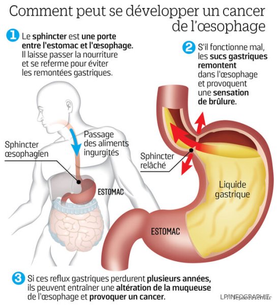 Le cancer de l'œsophage est-il une mort douloureuse ? La réalité crue sur la fin de vie et les soins palliatifs actuels