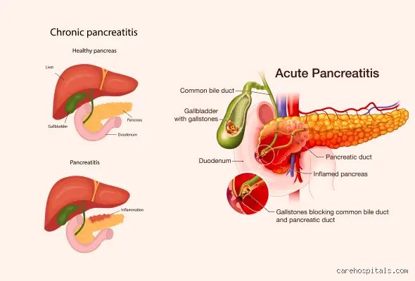 Le pancréas retrouve-t-il son fonctionnement normal après une pancréatite aiguë ? Ce que la science nous cache encore