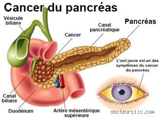 Les kystes pancréatiques disparaissent-ils un jour ? Ce que la science nous dit vraiment sur ces découvertes fortuites