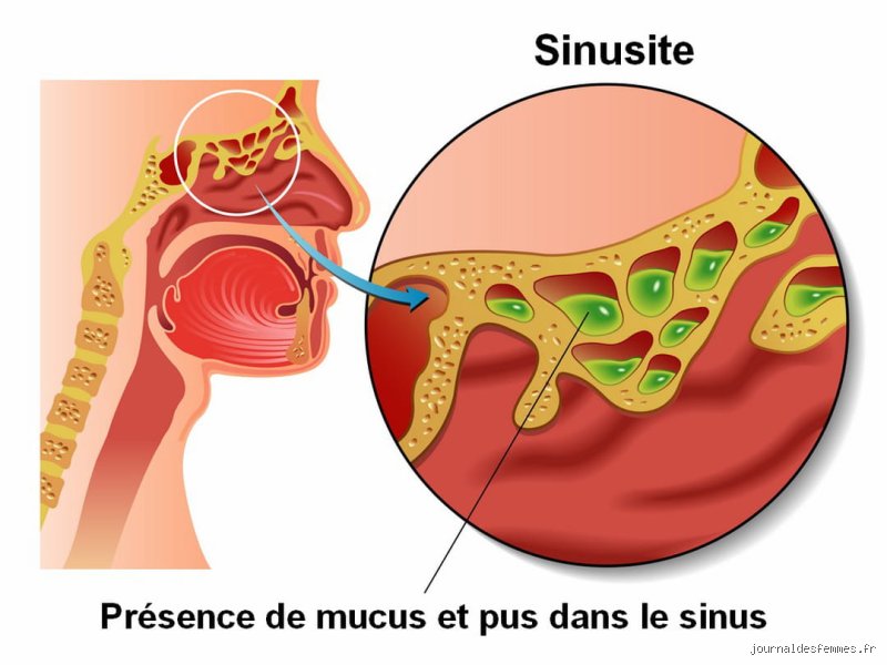Les sinus peuvent-ils être complètement obstrués ? Ce que la médecine ORL ne vous dit pas toujours