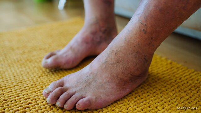 Marcher pieds nus est-il bon pour les diabétiques : le guide sans filtre sur les bénéfices supposés et les dangers réels
