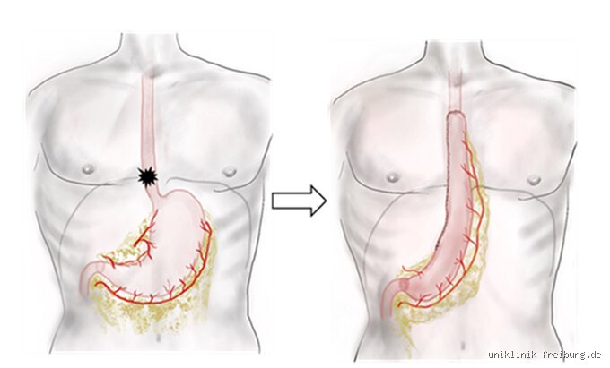 Où se propage le cancer de l'œsophage ? Comprendre les trajectoires et les sites de métastases de cette tumeur silencieuse