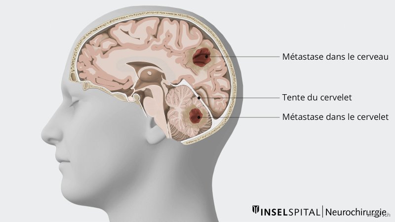 Où se situe la douleur lorsqu'une tumeur cérébrale est présente : comprendre la topographie fine des céphalées oncologiques