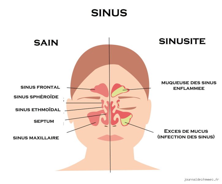 Peut-on guérir définitivement des sinus ? Ce que la science et les ORL cachent parfois aux patients chroniques