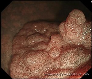 Peut-on guérir une tumeur sans chirurgie ? Le grand virage de l'oncologie moderne vers l'ablation non invasive