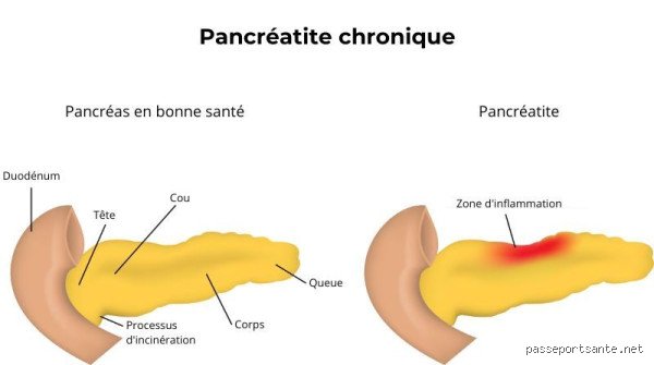 Peut-on vivre avec une pancréatite sévère ? Comprendre la réalité brutale d'une survie possible mais complexe