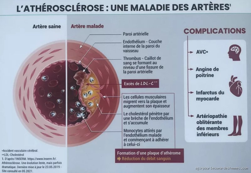 Peut-on vivre longtemps avec de la plaque dans les artères ? Ce que la science nous cache sur la longévité cardiaque