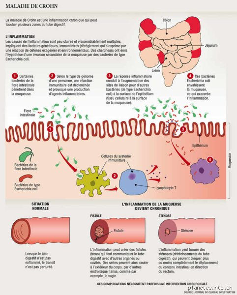 Pourquoi ai-je l'intestin enflammé ? Comprendre enfin les mécanismes cachés de cette inflammation digestive qui vous gâche la vie