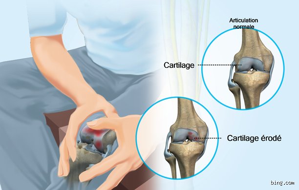 Pourquoi j'ai beaucoup d'arthrose ?