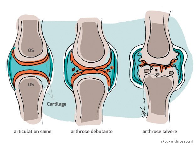 Comprendre pourquoi l'arthrose est une maladie dégénérative qui touche des millions de Français au quotidien