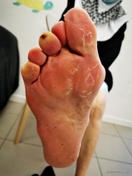 Pourquoi les diabétiques ne peuvent-ils pas marcher pieds nus ? Les dangers cachés d'une liberté qui peut coûter une jambe