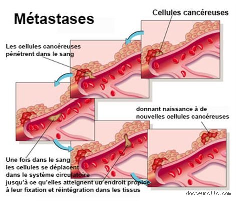 Pourquoi les métastases font mal ? Comprendre enfin la mécanique brutale de la douleur cancéreuse