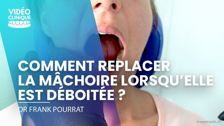 Pourquoi ma mâchoire se déboite-t-elle : les vraies raisons derrière ce phénomène troublant