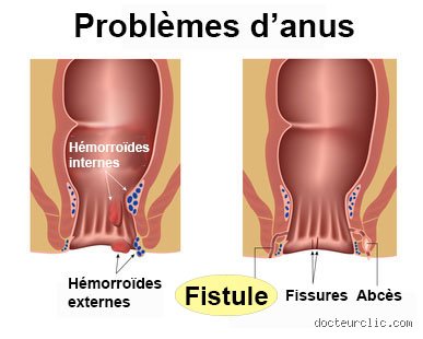 Pourquoi mon anus est-il serré ? Comprendre les tensions rectales et les solutions médicales concrètes