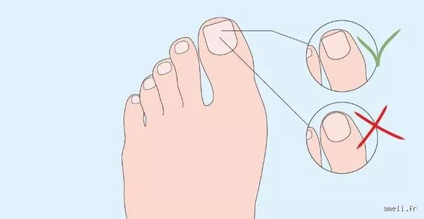 Pourquoi ne pas couper les ongles d’un diabétique soi-même : les dangers cachés derrière un geste banal