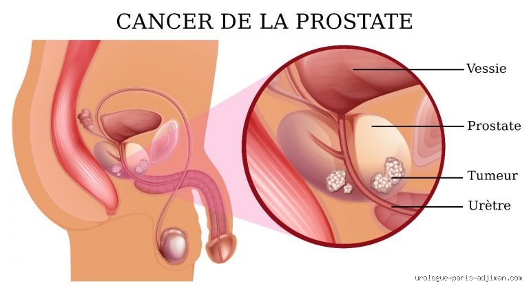 Pourrai-je mener une vie normale après l'ablation de ma prostate : ce que personne ne vous dit vraiment sur l'après-chirurgie