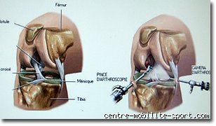 Qu'est-ce qu'un nettoyage articulaire du genou et pourquoi cette intervention divise-t-elle autant les chirurgiens orthopédiques aujourd'hui ?