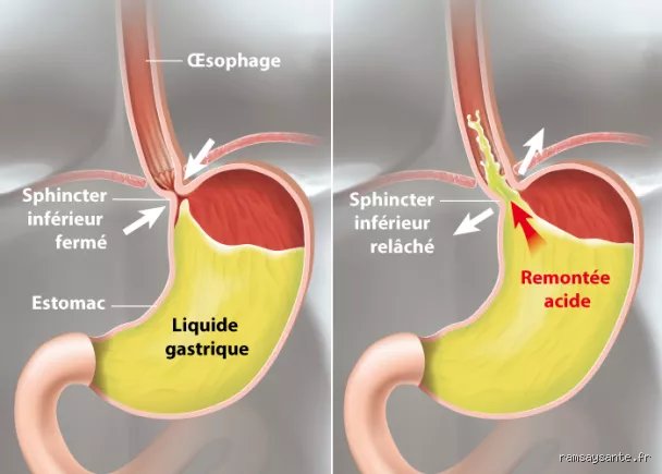 Qu’est-ce que la maladie de reflux gastro-œsophagien (RGO) ? Tout comprendre sur cette pathologie silencieuse qui brûle votre quotidien