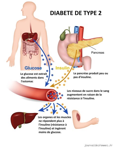 Qu'est-ce que le diabète de type 2 ? Comprendre enfin cette épidémie silencieuse qui bouleverse notre métabolisme moderne