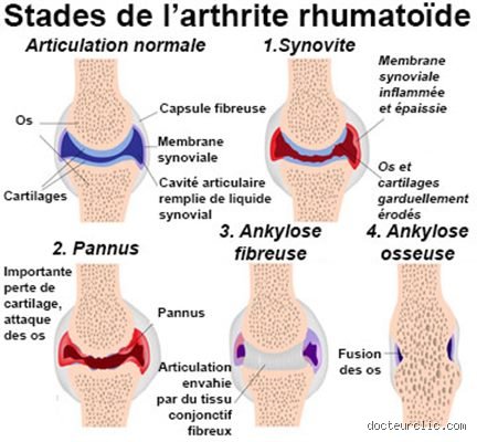Qu'est-ce qui aggrave la polyarthrite rhumatoïde ? Comprendre les mécanismes et les facteurs de risque insoupçonnés qui exacerbent l'inflammation