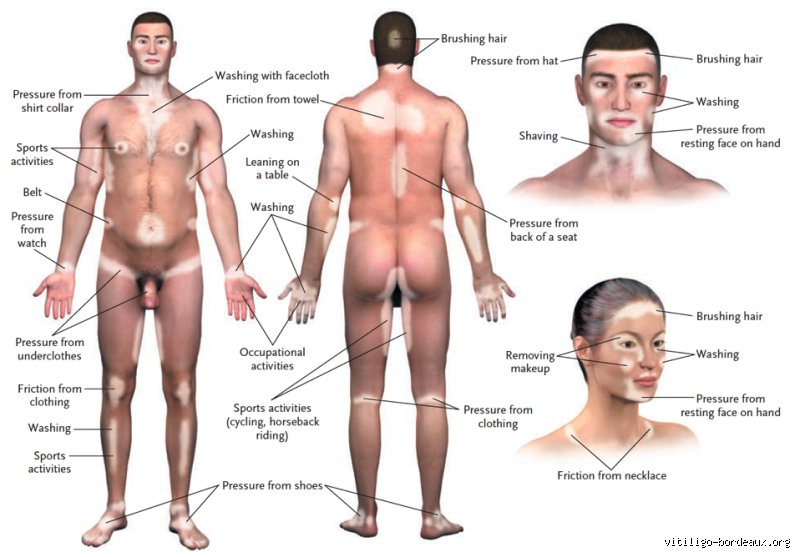 Comprendre ce qui aggrave le vitiligo au quotidien et comment la science tente de freiner la dépigmentation cutanée