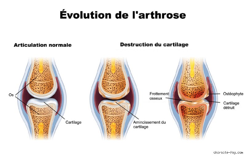 Qu'est-ce qui déclenche une crise d'arthrose ? Le guide complet pour comprendre les mécanismes de la douleur articulaire brutale