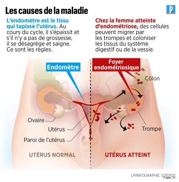 Qu’est-ce qui déclenche une poussée d’endométriose ? Comprendre les mécanismes inflammatoires et les facteurs environnementaux cachés