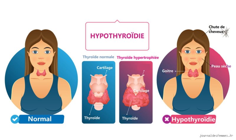 Qu’est-ce qui épuise les réserves d’iode de votre corps ? Enquête sur un vol silencieux qui fragilise votre thyroïde