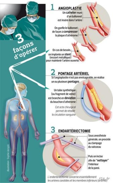 Qu’est-ce qui obstrue réellement les artères ? La vérité sur le mécanisme complexe de l’athérosclérose au-delà du simple gras
