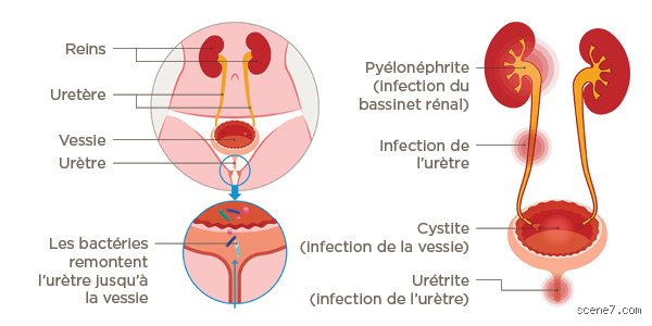 Qu’est-ce qui peut être diagnostiqué à tort comme une infection urinaire : les pièges d'un diagnostic trop rapide