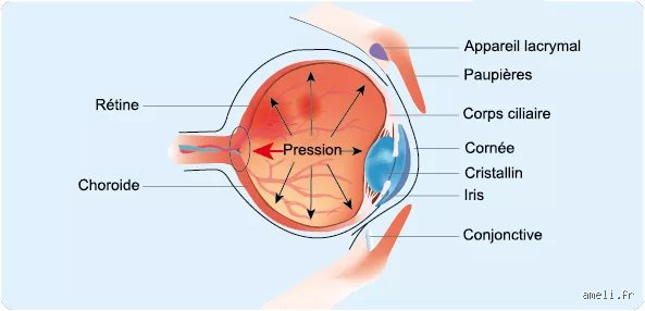 Qu'est-ce qui provoque la pression dans les yeux ?