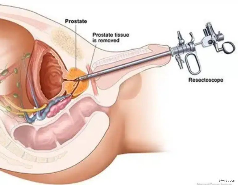 Qu'est-ce qui réduit naturellement le volume de la prostate  ?