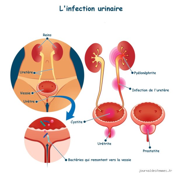 Qu’est-ce qui tue naturellement les bactéries présentes dans les voies urinaires : la vérité scientifique au-delà des remèdes de grand-mère