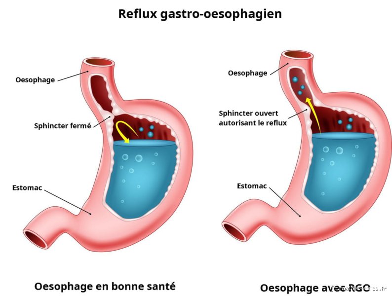 Quand dois-je m'inquiéter pour mon œsophage ? Comprendre les signaux d'alerte et les risques réels