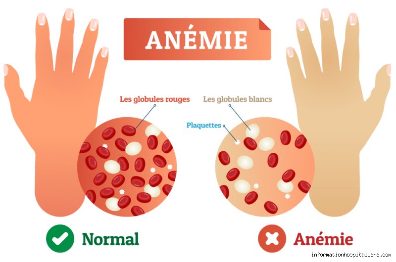 Quand l'anémie devient-elle dangereuse ? Comprendre enfin les seuils critiques pour ne plus ignorer les signaux d'alarme de votre corps
