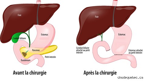 Que fait un hôpital en cas de pancréatite ? Le parcours de soins complet entre urgences et réanimation