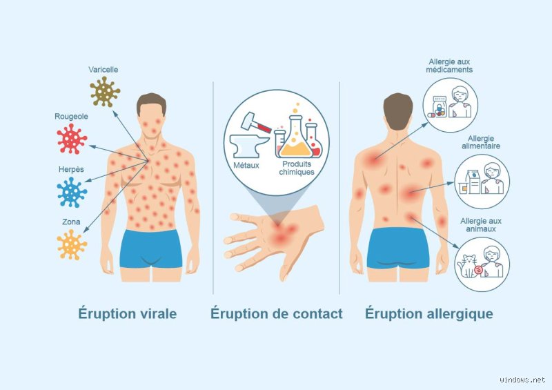 Que ne faut-il pas faire en cas d'éruption cutanée ? Les erreurs fatales qui aggravent votre peau