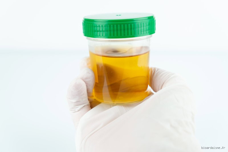 Que se passe-t-il si mon test d'urine est positif à E. coli ? Comprendre les résultats et les étapes médicales immédiates