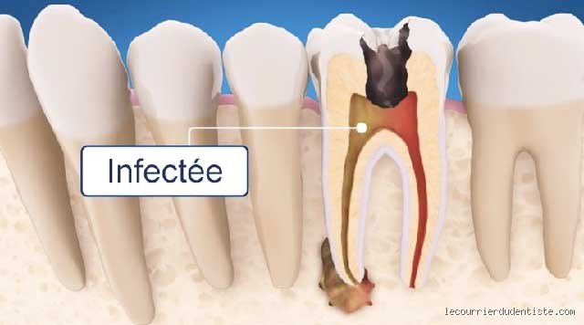 Que se passe-t-il si une infection n'est pas traitée ? Les mécanismes biologiques d'une escalade silencieuse vers le choc systémique