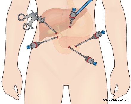 Que se passe-t-il si vous ne allez pas à l'hôpital pour une pancréatite ? Les risques réels d'une attente prolongée