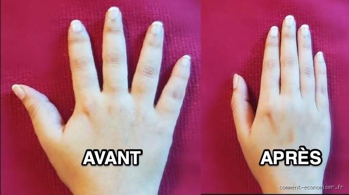 Quel doigt serait le pire à perdre ? Classement médical et impact fonctionnel d'une amputation digitale